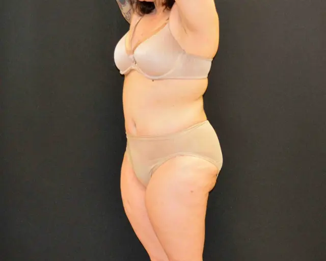 Tummy Tuck after at Campanile Plastic Surgery in Denver, CO