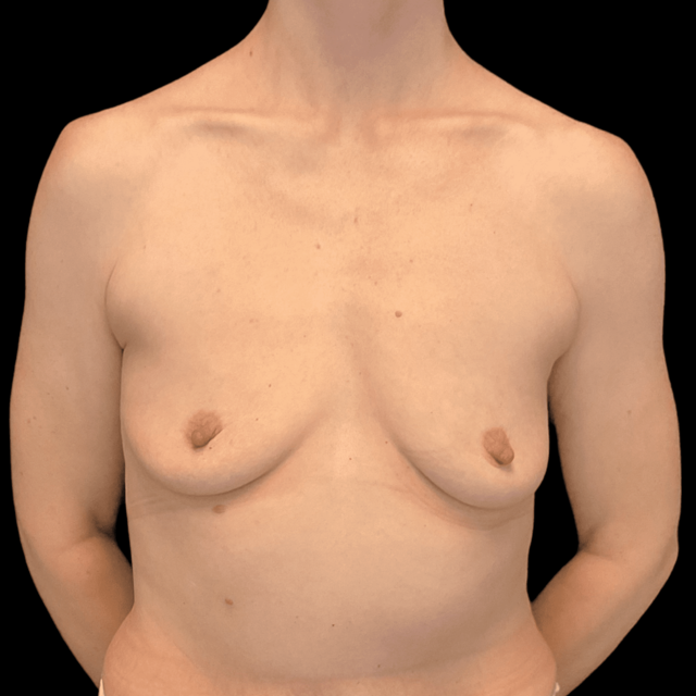 Breast Augmentation before at Campanile Plastic Surgery in Denver, CO