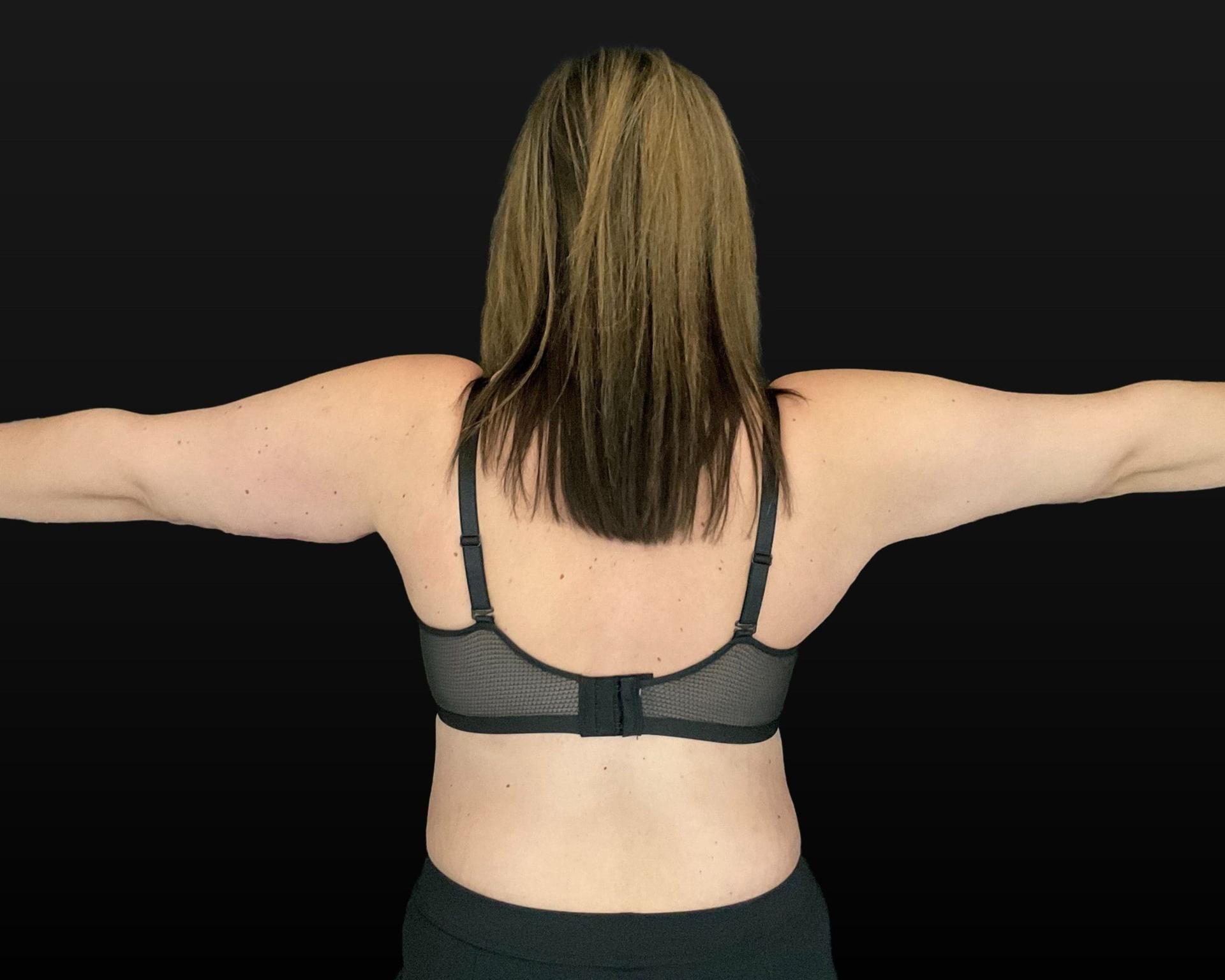 Campanile Plastic Surgery arm lift after — Denver, CO