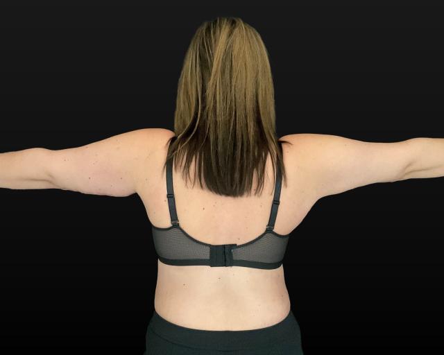 Arm Lift after at Campanile Plastic Surgery in Denver, CO