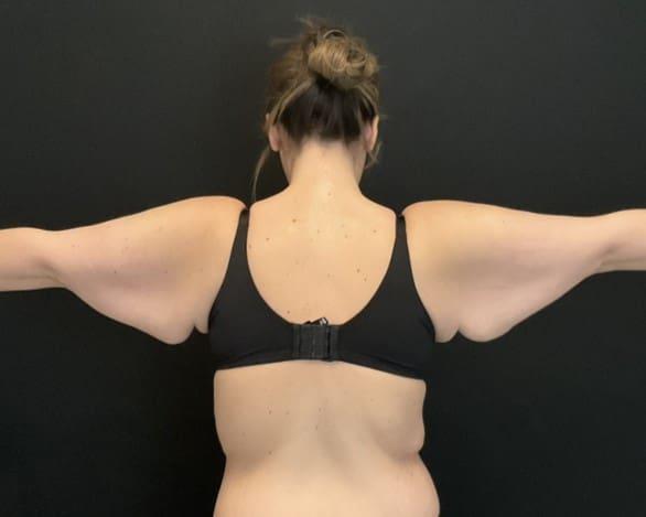 Arm Lift before at Campanile Plastic Surgery in Denver, CO