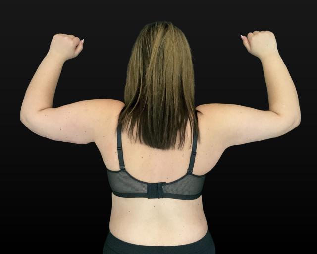 Arm Lift after at Campanile Plastic Surgery in Denver, CO