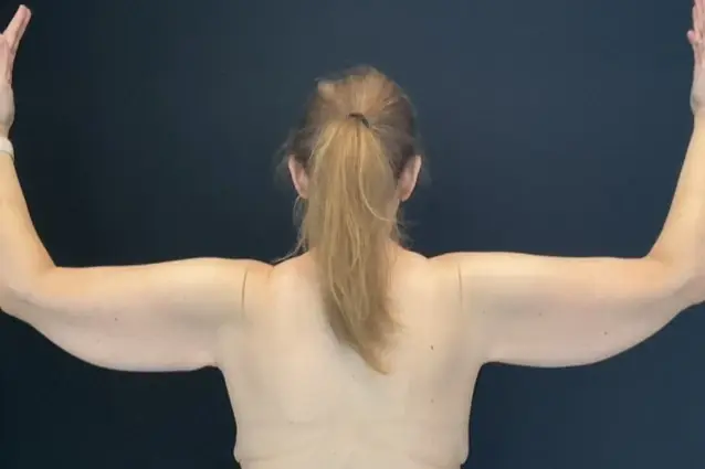 Arm Lift before at Campanile Plastic Surgery in Denver, CO