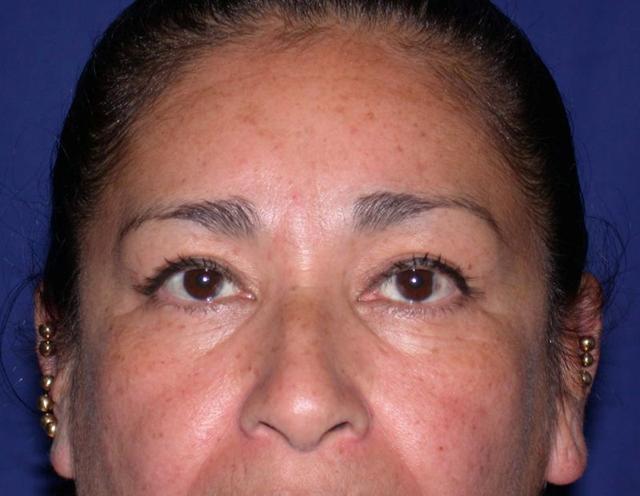 Blepharoplasty after at Dr. Kenneth Bermudez, MD in San Francisco, CA