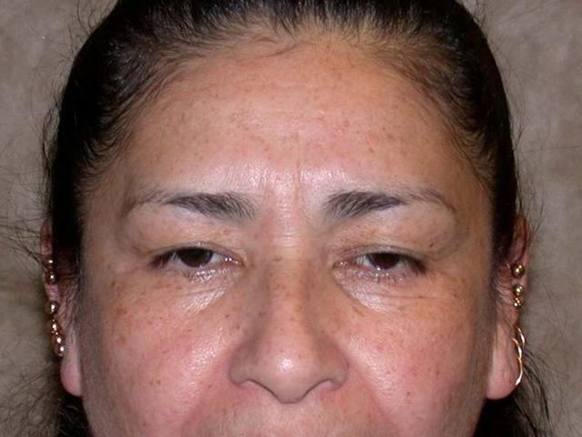 Blepharoplasty before at Dr. Kenneth Bermudez, MD in San Francisco, CA