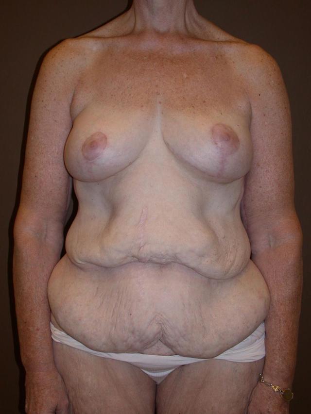 Mommy Makeover before at Dr. Kenneth Bermudez, MD in San Francisco, CA