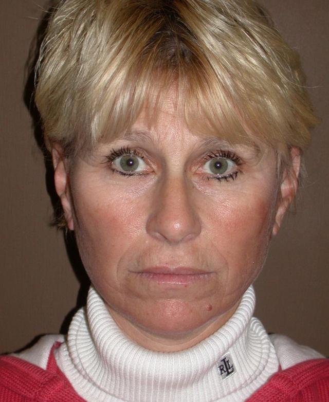 Deep Plane Facelift after at Dr. Kenneth Bermudez, MD in San Francisco, CA