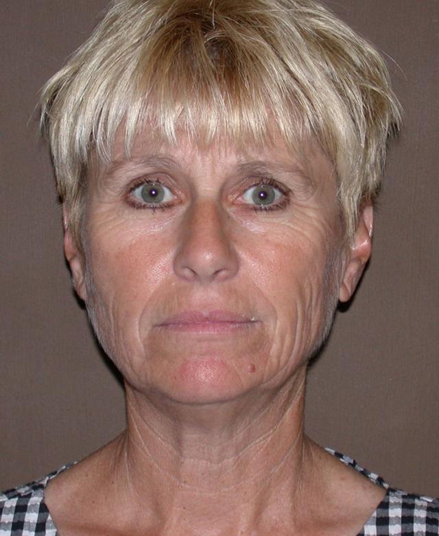 Deep Plane Facelift before at Dr. Kenneth Bermudez, MD in San Francisco, CA