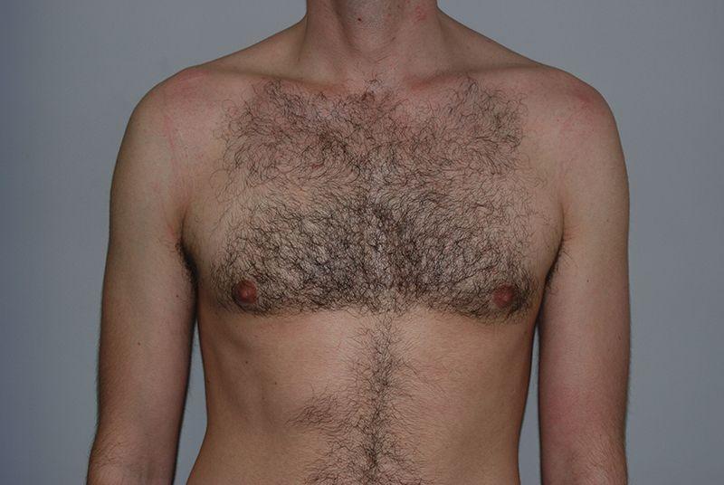 Dr. Kenneth Bermudez, MD gynecomastia after — San Francisco, CA