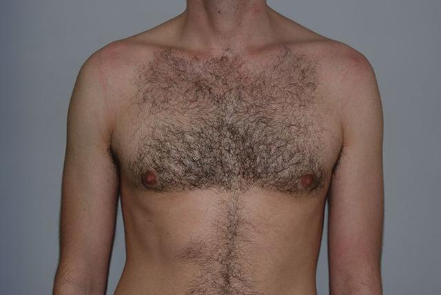 Gynecomastia Surgery after at Dr. Kenneth Bermudez, MD in San Francisco, CA