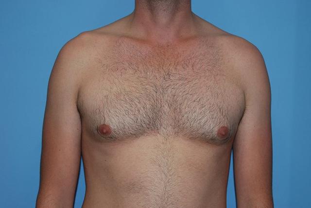 Gynecomastia Surgery before at Dr. Kenneth Bermudez, MD in San Francisco, CA