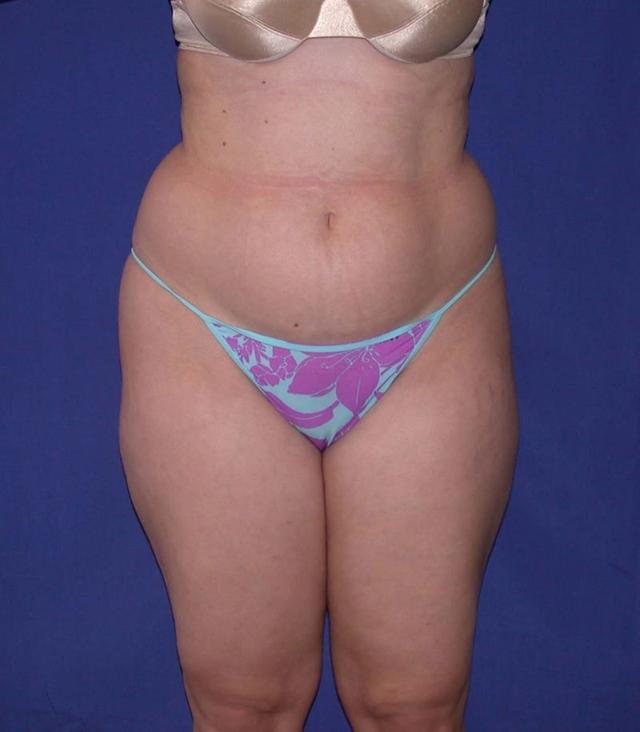 Mini Tummy Tuck before at Dr. Kenneth Bermudez, MD in San Francisco, CA