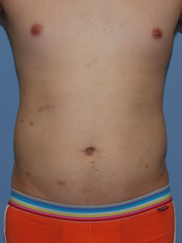 Liposuction before at Dr. Kenneth Bermudez, MD in San Francisco, CA