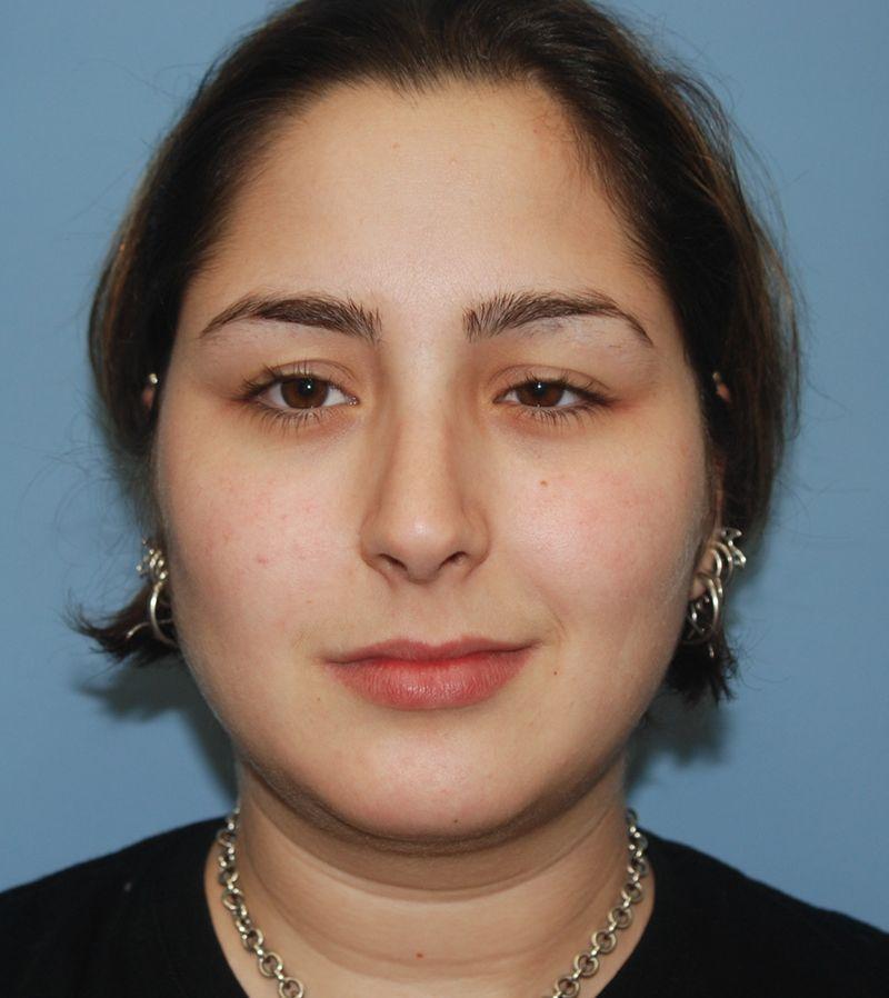 Dr. Kenneth Bermudez, MD rhinoplasty after — San Francisco, CA