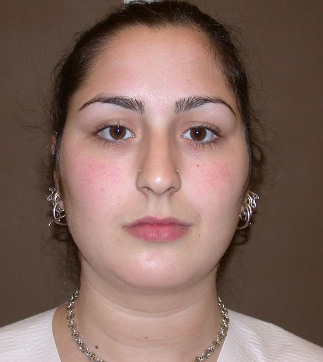 Rhinoplasty before at Dr. Kenneth Bermudez, MD in San Francisco, CA