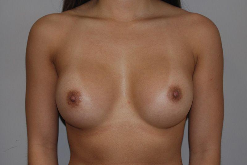 Dr. Kenneth Bermudez, MD breast augmentation after — San Francisco, CA