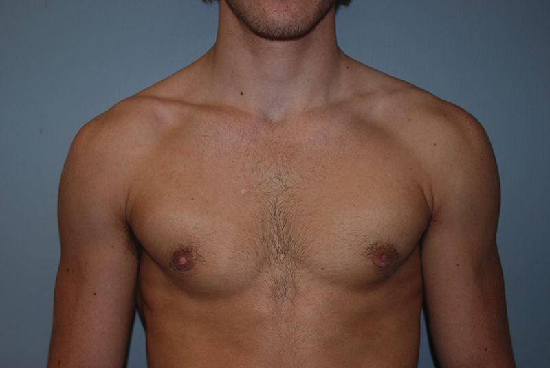 Dr. Kenneth Bermudez, MD gynecomastia after — San Francisco, CA