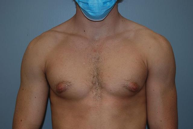 Gynecomastia Surgery before at Dr. Kenneth Bermudez, MD in San Francisco, CA