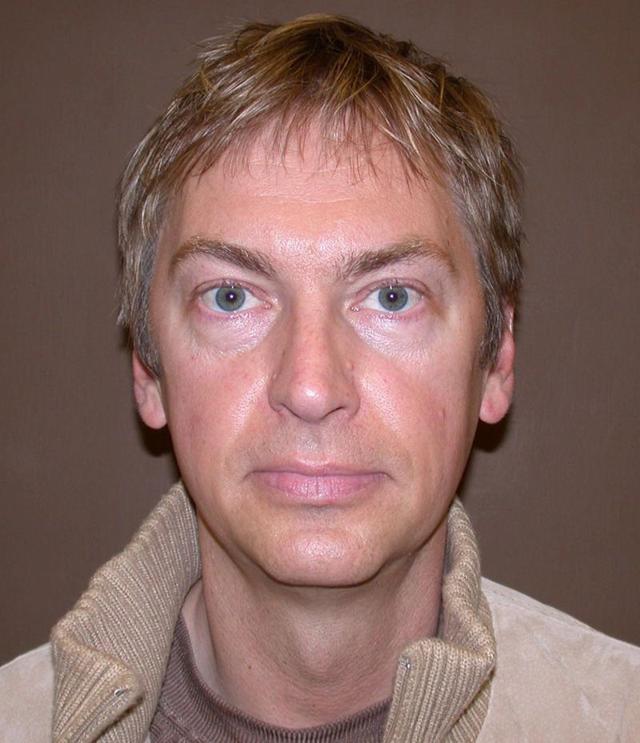 Rhinoplasty after at Dr. Kenneth Bermudez, MD in San Francisco, CA