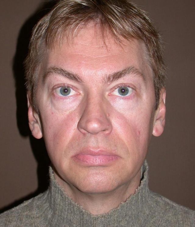 Rhinoplasty before at Dr. Kenneth Bermudez, MD in San Francisco, CA