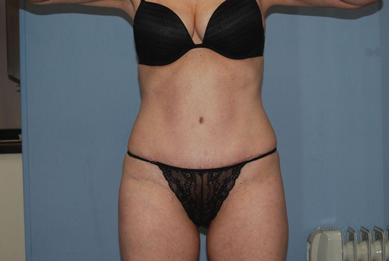 Dr. Kenneth Bermudez, MD tummy tuck after — San Francisco, CA
