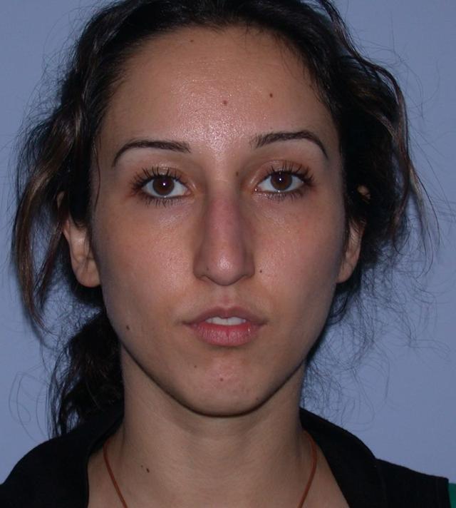 Rhinoplasty before at Dr. Kenneth Bermudez, MD in San Francisco, CA