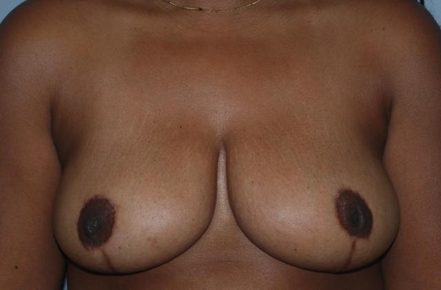 Breast Reduction after at Dr. Kenneth Bermudez, MD in San Francisco, CA