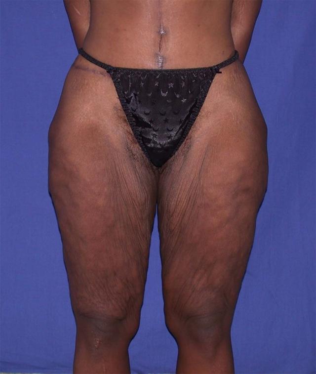 Thigh Lift before at Dr. Kenneth Bermudez, MD in San Francisco, CA