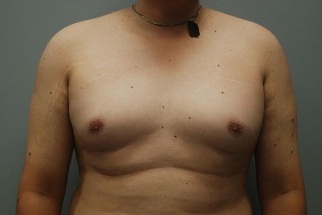 Gynecomastia Surgery before at Dr. Kenneth Bermudez, MD in San Francisco, CA