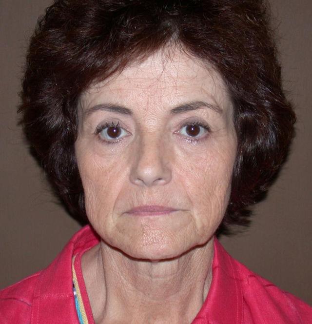 Deep Plane Facelift before at Dr. Kenneth Bermudez, MD in San Francisco, CA