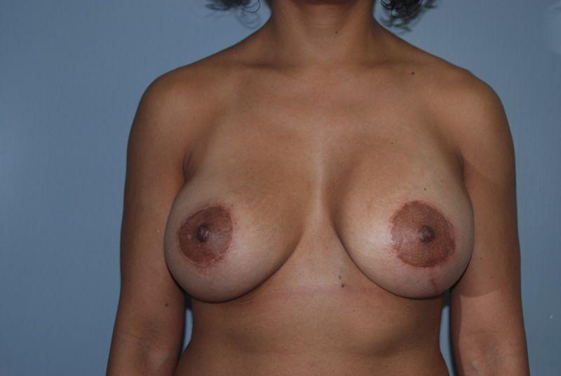 Dr. Kenneth Bermudez, MD breast lift after — San Francisco, CA