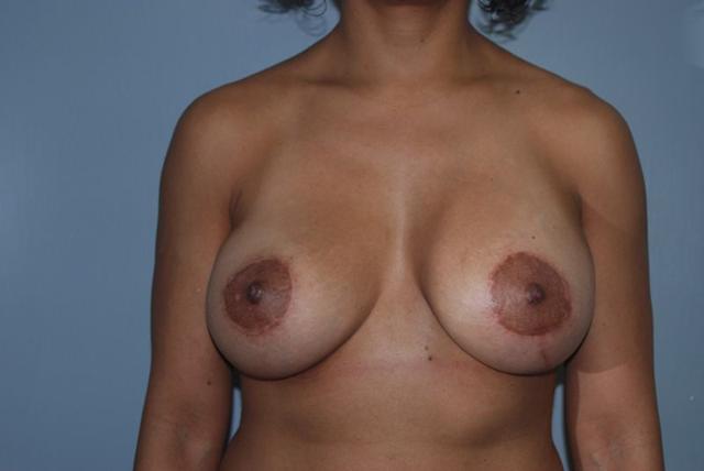 Breast Lift after at Dr. Kenneth Bermudez, MD in San Francisco, CA