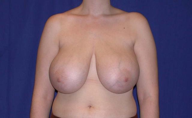 Breast Reduction before at Dr. Kenneth Bermudez, MD in San Francisco, CA