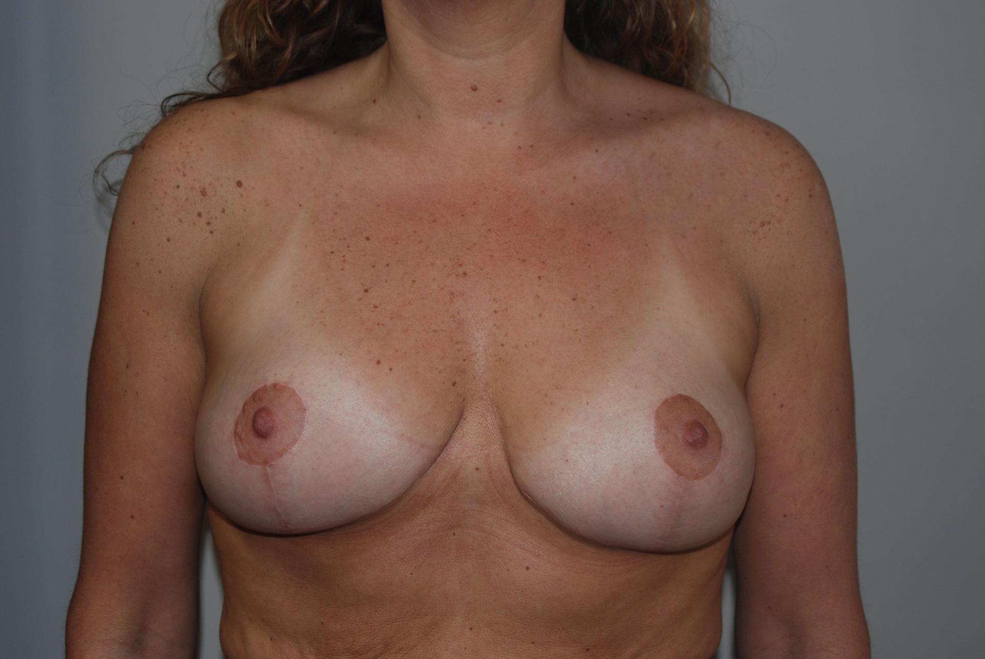 Dr. Kenneth Bermudez, MD breast lift after — San Francisco, CA