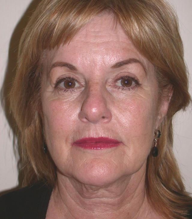 Deep Plane Facelift before at Dr. Kenneth Bermudez, MD in San Francisco, CA