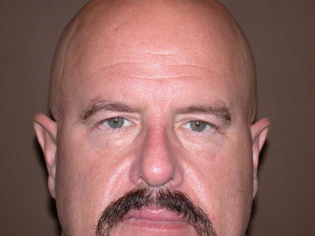 Blepharoplasty before at Dr. Kenneth Bermudez, MD in San Francisco, CA