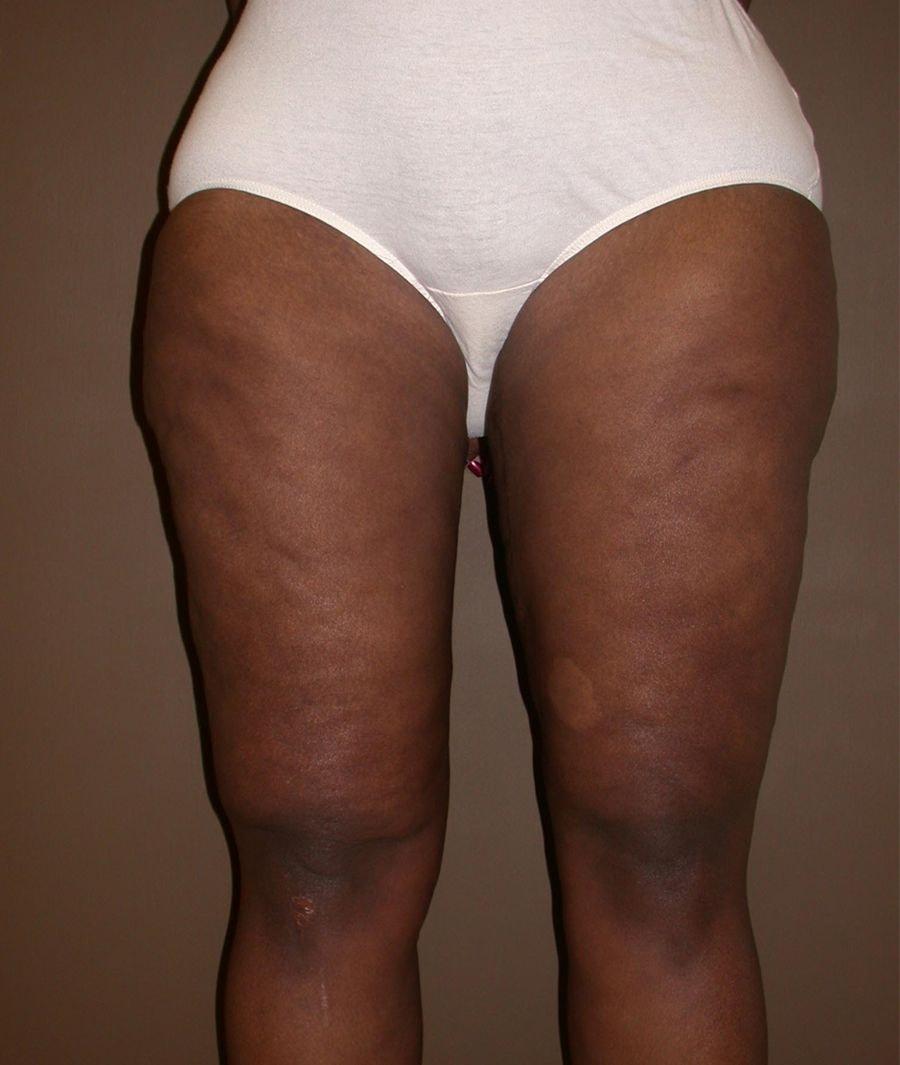 Dr. Kenneth Bermudez, MD thigh lift after — San Francisco, CA