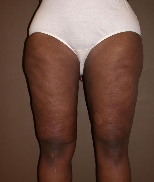 Thigh Lift after at Dr. Kenneth Bermudez, MD in San Francisco, CA