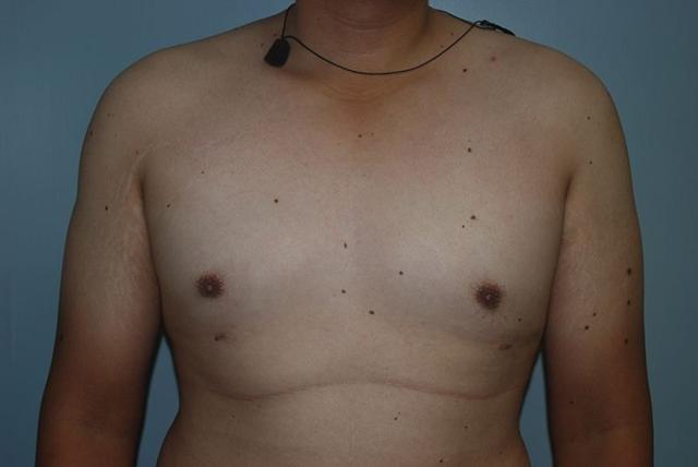 Gynecomastia Surgery after at Dr. Kenneth Bermudez, MD in San Francisco, CA