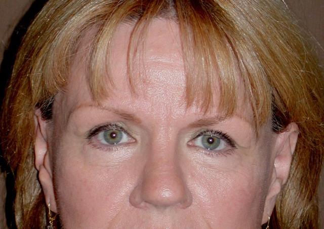 Blepharoplasty after at Dr. Kenneth Bermudez, MD in San Francisco, CA