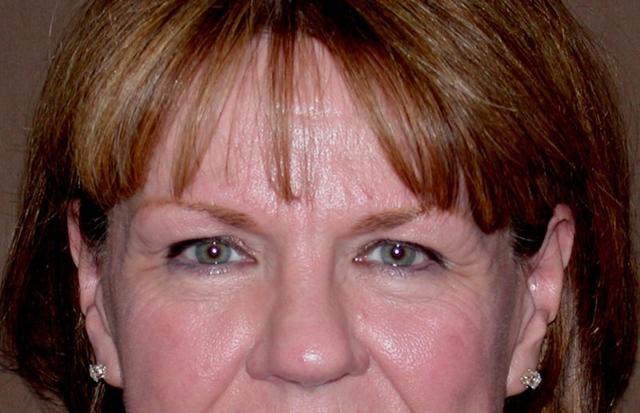 Blepharoplasty before at Dr. Kenneth Bermudez, MD in San Francisco, CA