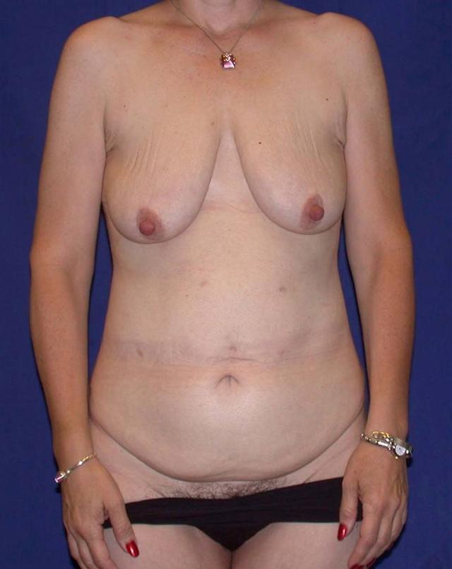 Tummy Tuck before at Dr. Kenneth Bermudez, MD in San Francisco, CA