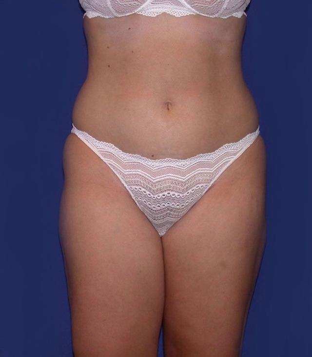 Mini Tummy Tuck after at Dr. Kenneth Bermudez, MD in San Francisco, CA