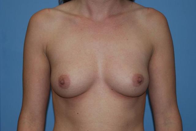 Breast Augmentation before at Dr. Kenneth Bermudez, MD in San Francisco, CA