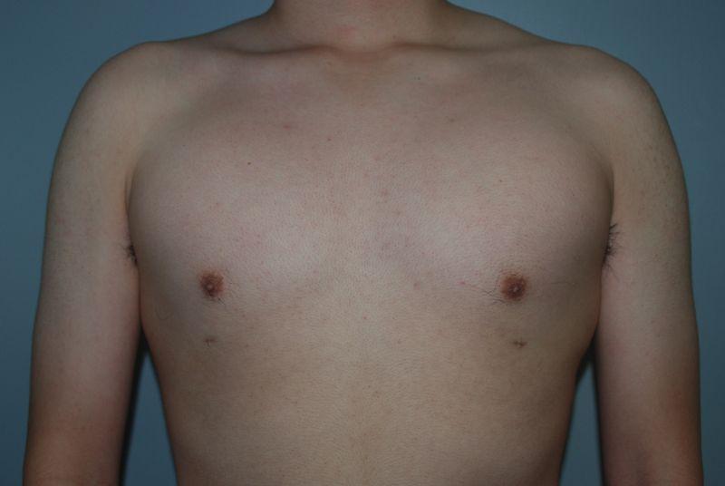 Dr. Kenneth Bermudez, MD gynecomastia after — San Francisco, CA