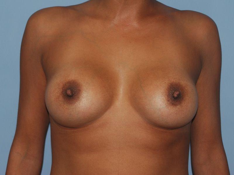 Dr. Kenneth Bermudez, MD breast augmentation after — San Francisco, CA