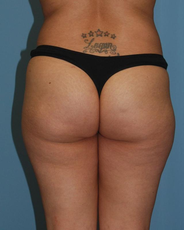 Brazilian Butt Lift before at Dr. Kenneth Bermudez, MD in San Francisco, CA