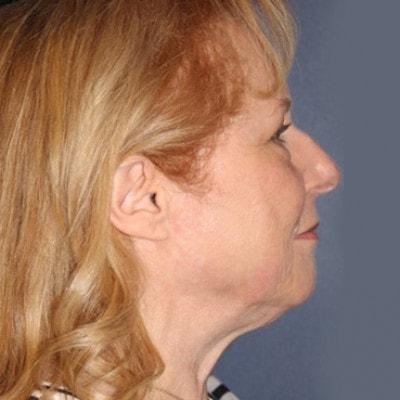 Neck Lift before at Samuel Lin, MD, FACS in Boston, MA