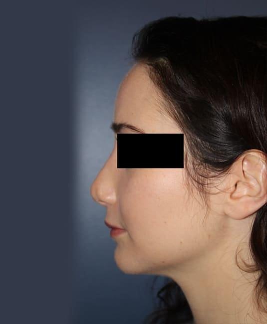 Rhinoplasty before at Samuel Lin, MD, FACS in Boston, MA