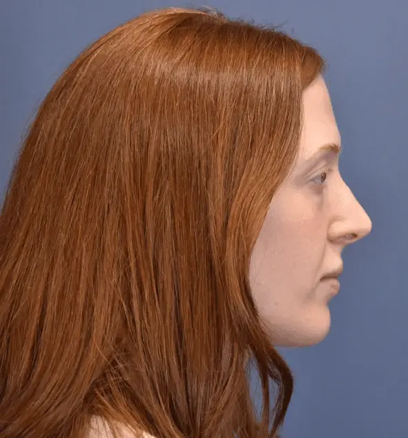 Rhinoplasty before at Samuel Lin, MD, FACS in Boston, MA